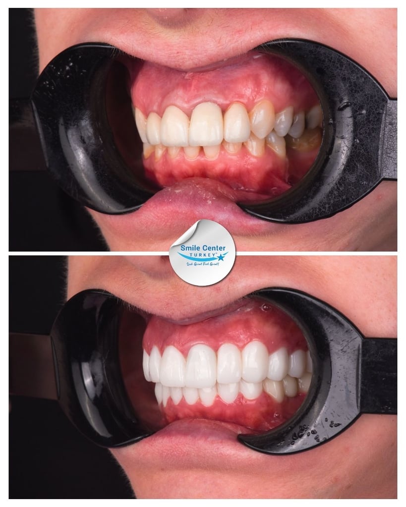 Side view of a patient's teeth showing stained, crooked teeth before treatment and white, straight teeth after dental restoration at Smile Center Turkey.