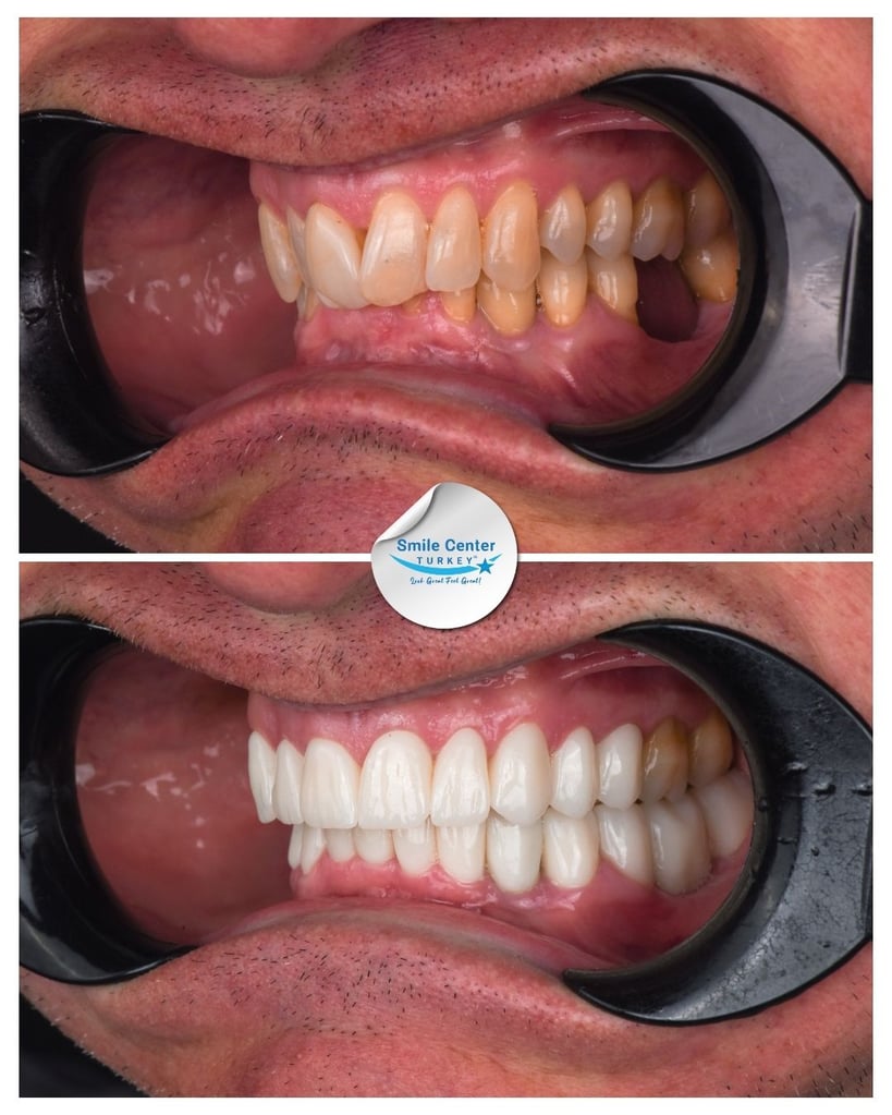 Before-and-after close-up side view of a patient's teeth with moustache; top image shows stained and crowded teeth; bottom shows bright, aligned white teeth after dental restoration at Smile Center Turkey.