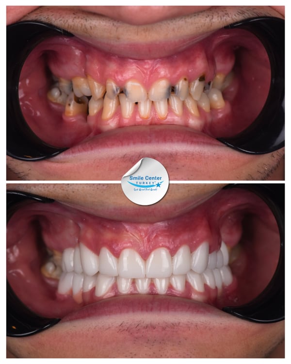 Dental scaling treatment in Turkey