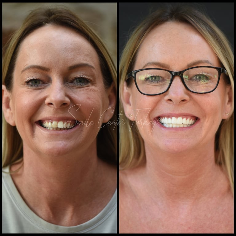 Blog – Smile Center Turkey®