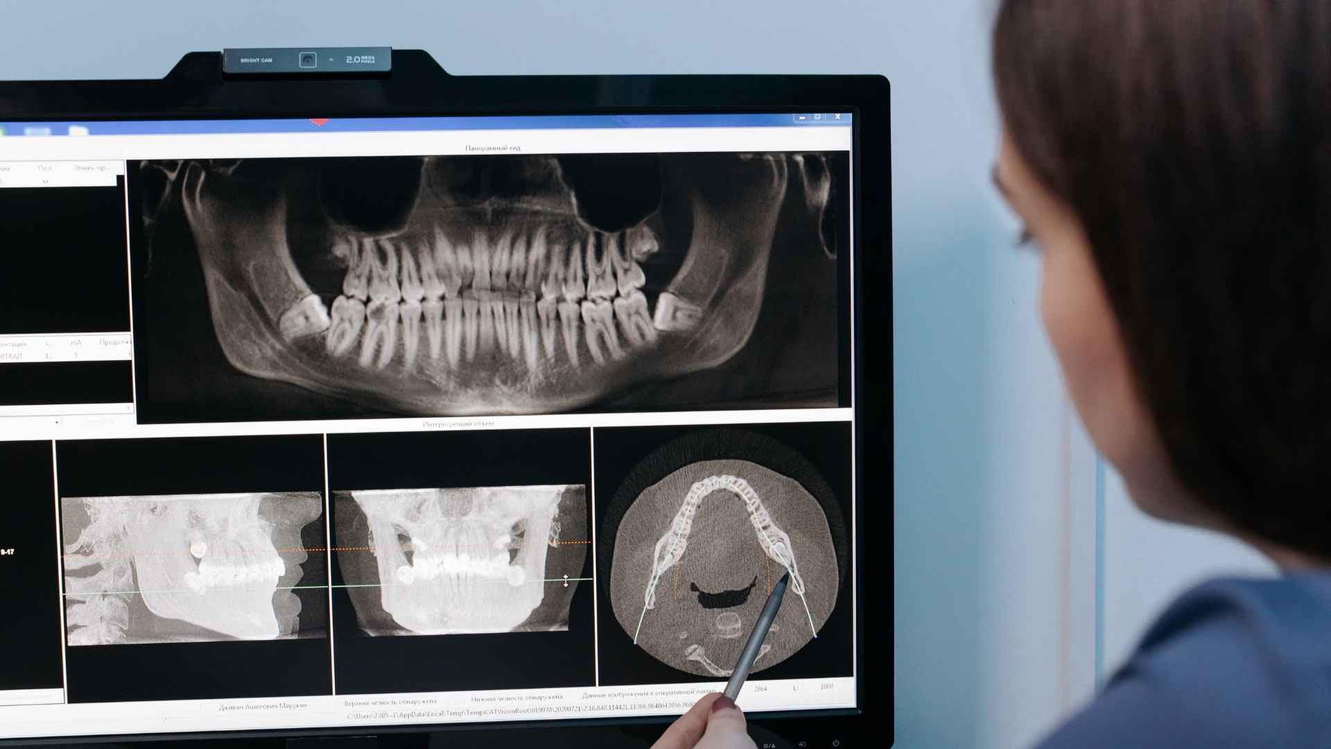 Close-up of a patient receiving composite dental fillings at a clinic in Turkey