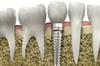 Delayed dental implant placement after tooth extraction Smile Center Turkey