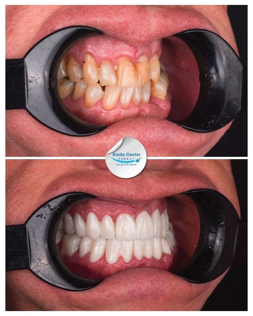Before and after front view of a patient's teeth using cheek retractors, showing severely crooked and yellow teeth before treatment and white, evenly aligned teeth after dental restoration at Smile Center Turkey.