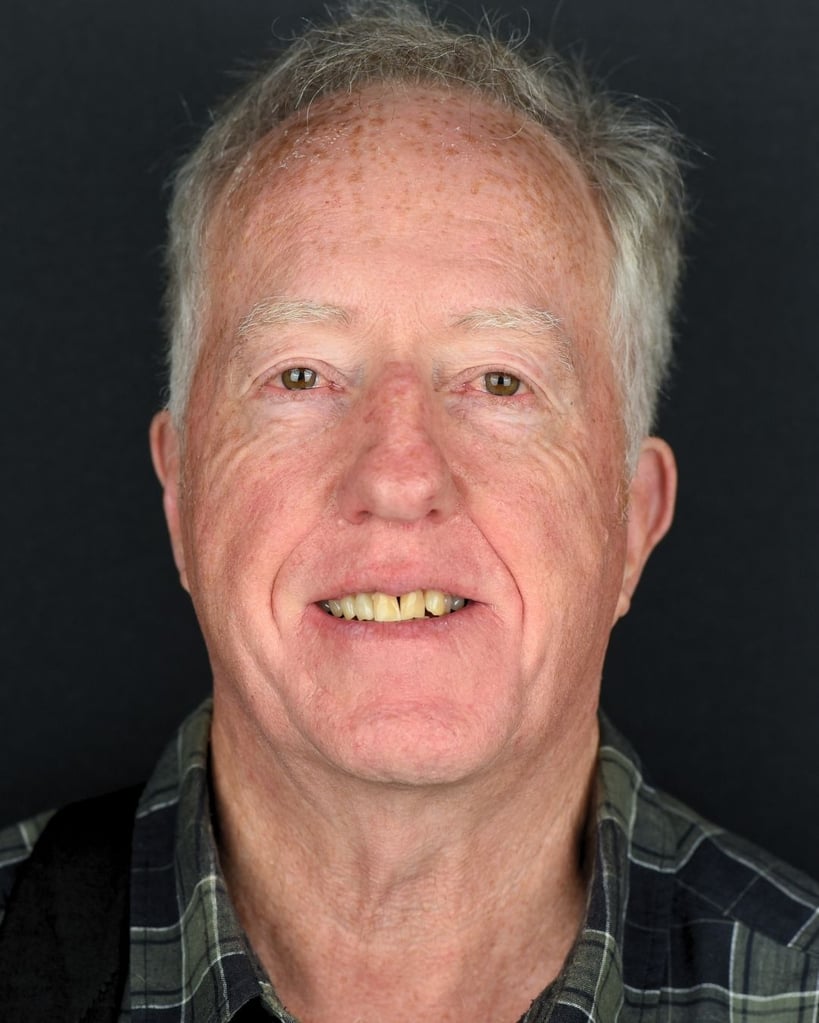 Portrait of an older man with short gray hair and freckles smiling slightly with yellowed teeth, wearing a green plaid shirt at Smile Center Turkey.