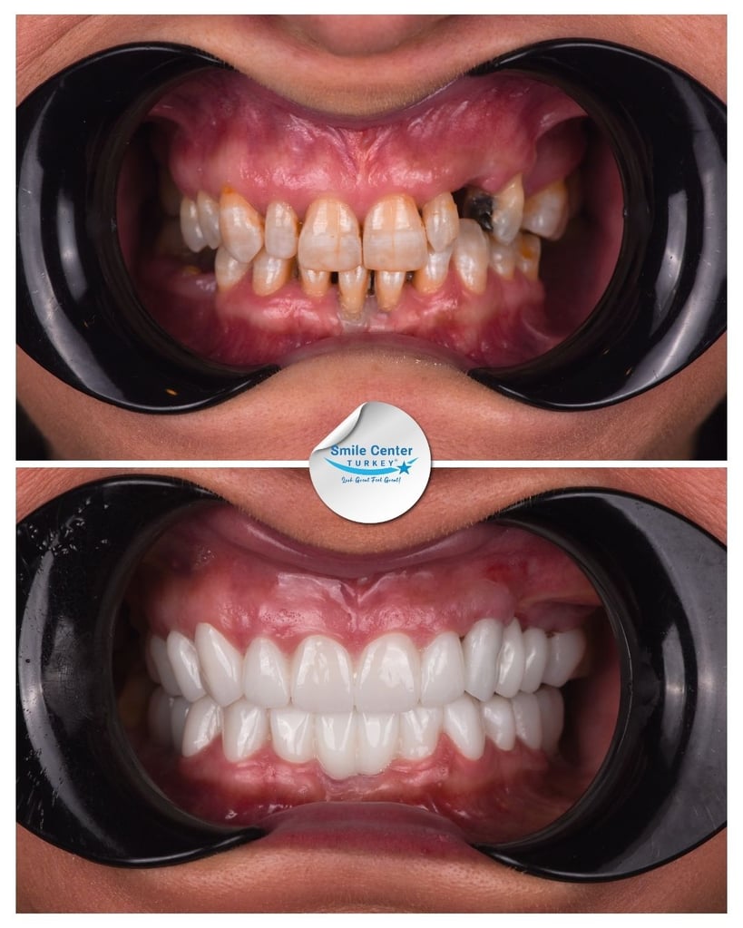 Before and after front view of a patient’s mouth showing severely decayed, misaligned and missing teeth before treatment and a full set of straight white teeth after dental restoration at Smile Center Turkey.