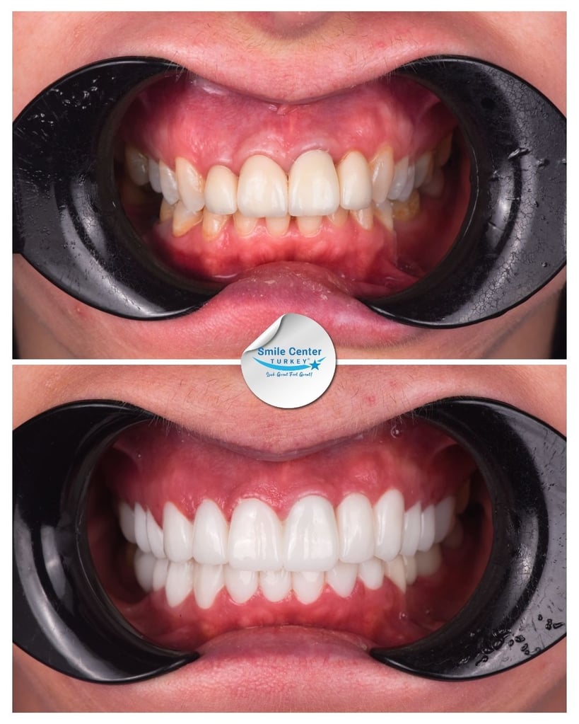 Before and after frontal view of a patient’s teeth showing yellow, misaligned teeth before treatment and straight, white teeth after dental restoration at Smile Center Turkey.