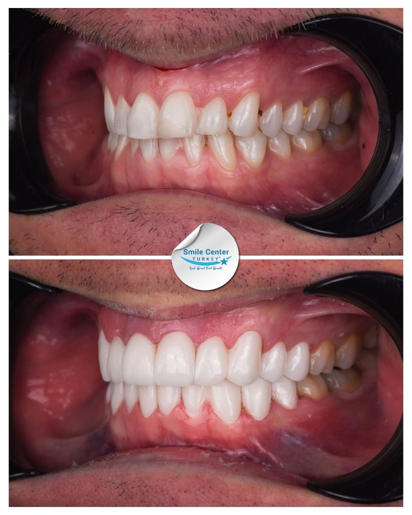 Before and after side view of a male patient's teeth showing misaligned, yellow teeth before treatment and straight white teeth after dental restoration at Smile Center Turkey.