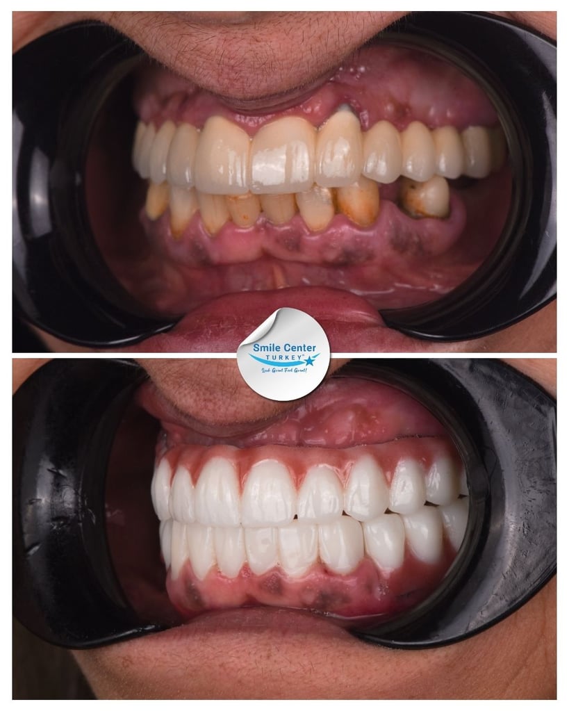 Before-and-after close-up of front teeth: top image shows stained, misaligned teeth; bottom shows bright, aligned white teeth after dental restoration at Smile Center Turkey.