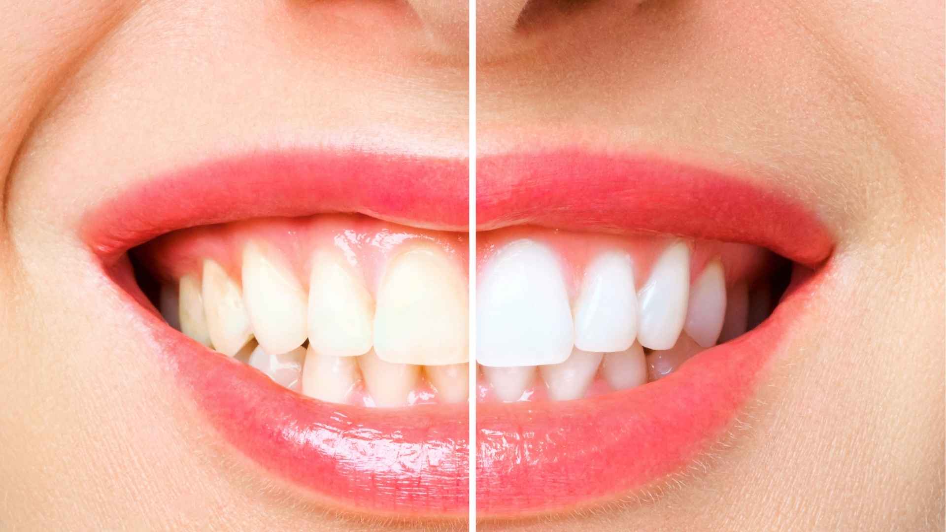 Before and after teeth whitening showing visible improvement in tooth colour and smile aesthetics