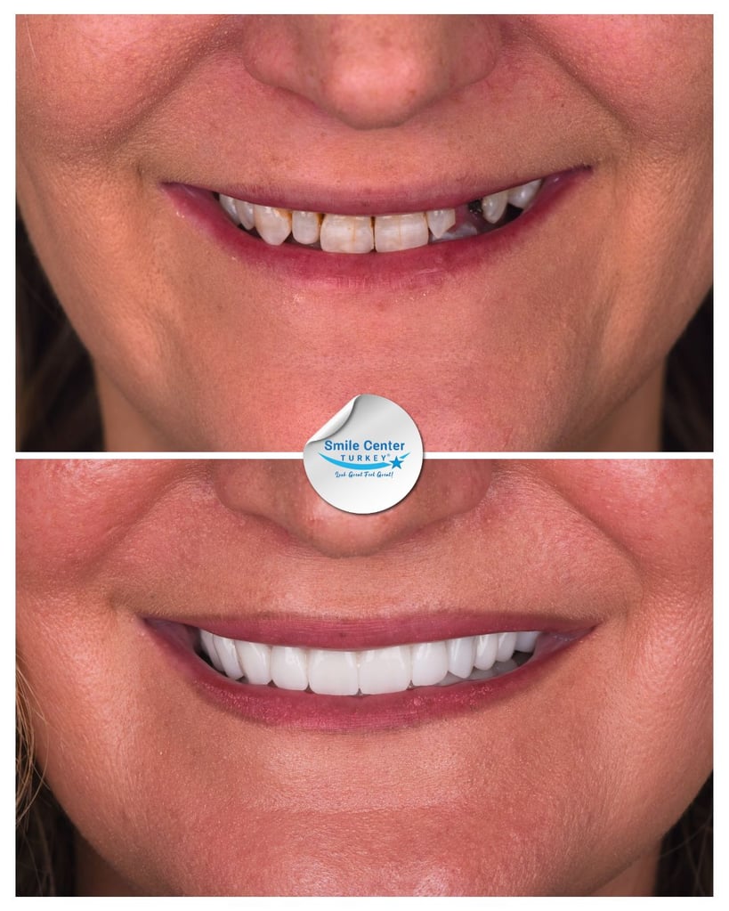 Before and after front view of a female patient’s smile showing missing and decayed upper teeth before treatment and bright, aligned white teeth after dental restoration at Smile Center Turkey.