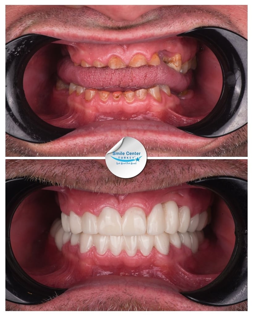 Before and after close-up of a patient’s mouth showing decayed, missing teeth and gums before treatment and a full set of white teeth after dental restoration at Smile Center Turkey.