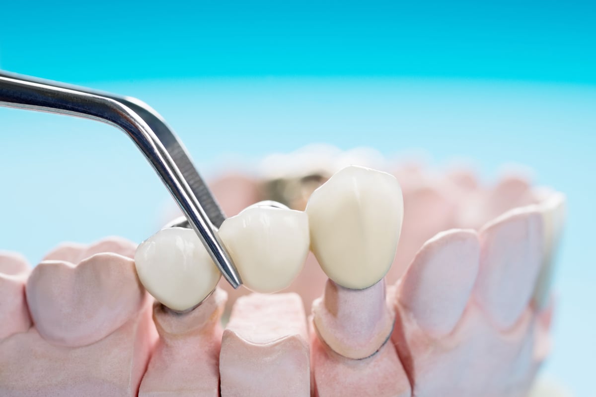 Dental bridge filling the gap of missing teeth