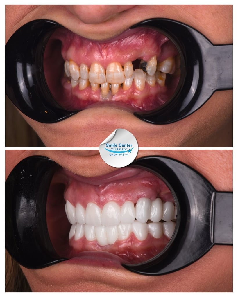 Before and after front view of a patient’s mouth showing crowded, yellow and decayed teeth before treatment and bright, straight white teeth after dental restoration at Smile Center Turkey.