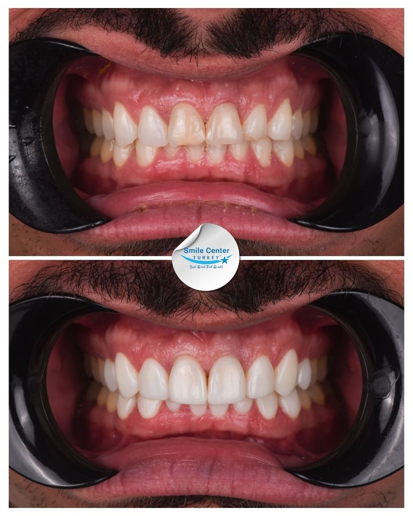 Before and after front view of a male patient's teeth with a moustache and cheek retractors, showing irregularly shaped teeth with gaps before treatment and white, evenly spaced teeth after dental restoration at Smile Center Turkey.