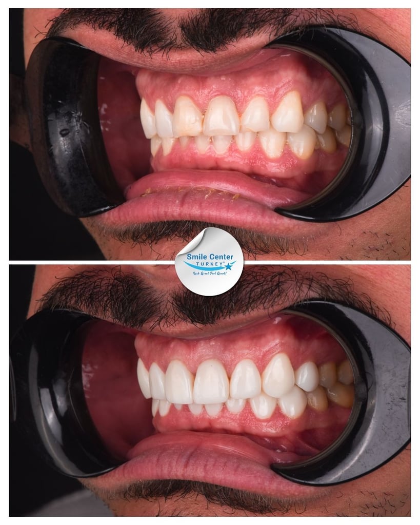 Before and after oblique view of a male patient's teeth with a moustache using cheek retractors, showing crooked, crowded teeth before treatment and white, evenly spaced teeth after dental restoration at Smile Center Turkey.