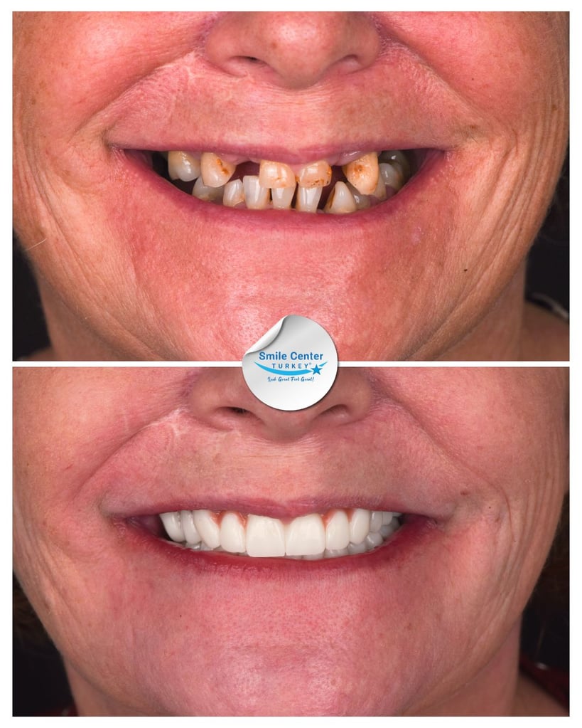Before and after close-up of a female patient's smile showing severely decayed and missing teeth before treatment and straight, natural-looking white teeth after dental restoration at Smile Center Turkey.