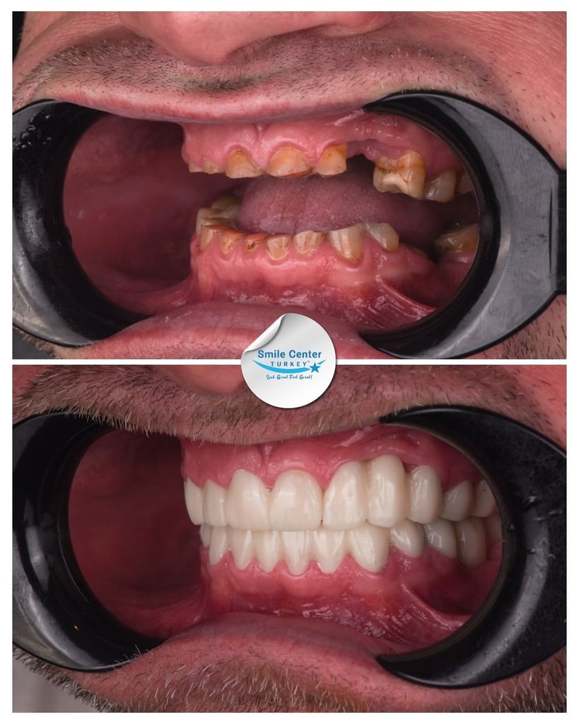 Before and after side view of a patient’s mouth showing missing upper teeth and decayed lower teeth before treatment, and a full set of white, straight teeth after dental restoration at Smile Center Turkey.