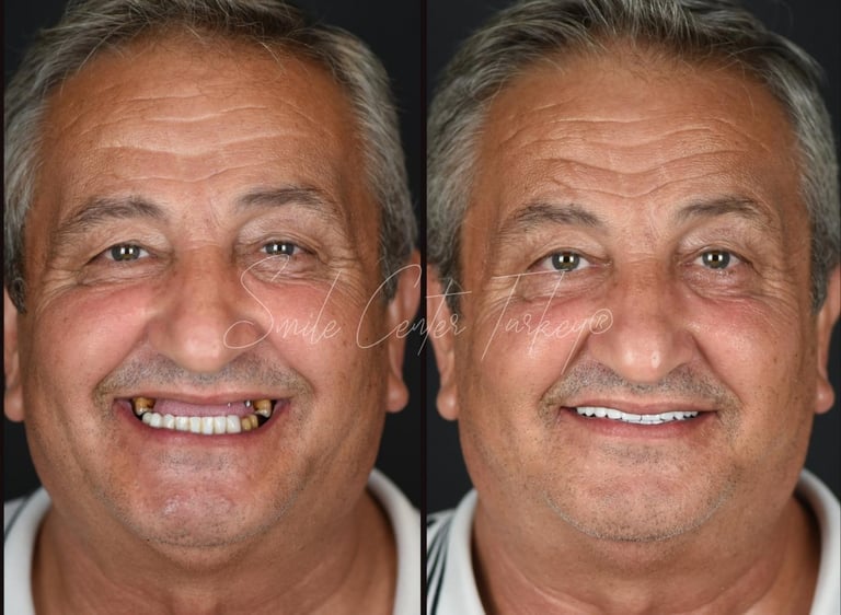Blog – Smile Center Turkey®