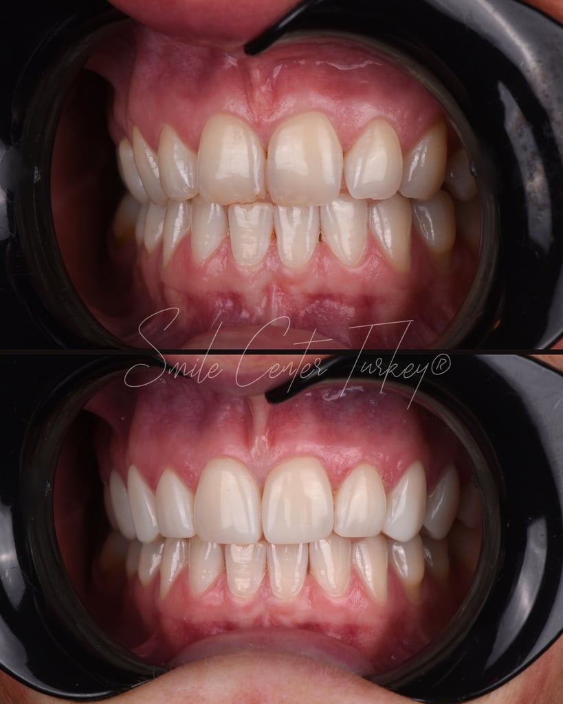 Victoria – Smile Center Turkey®