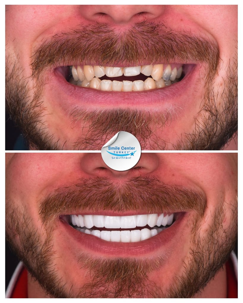 Before and after close-up of a man's smile with a moustache showing yellowed, misaligned teeth before treatment and bright white teeth after dental restoration at Smile Center Turkey.