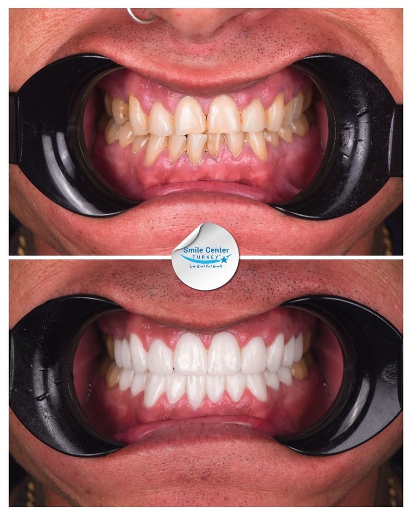 Before and after dental treatment showing teeth restoration at Smile Center Turkey.