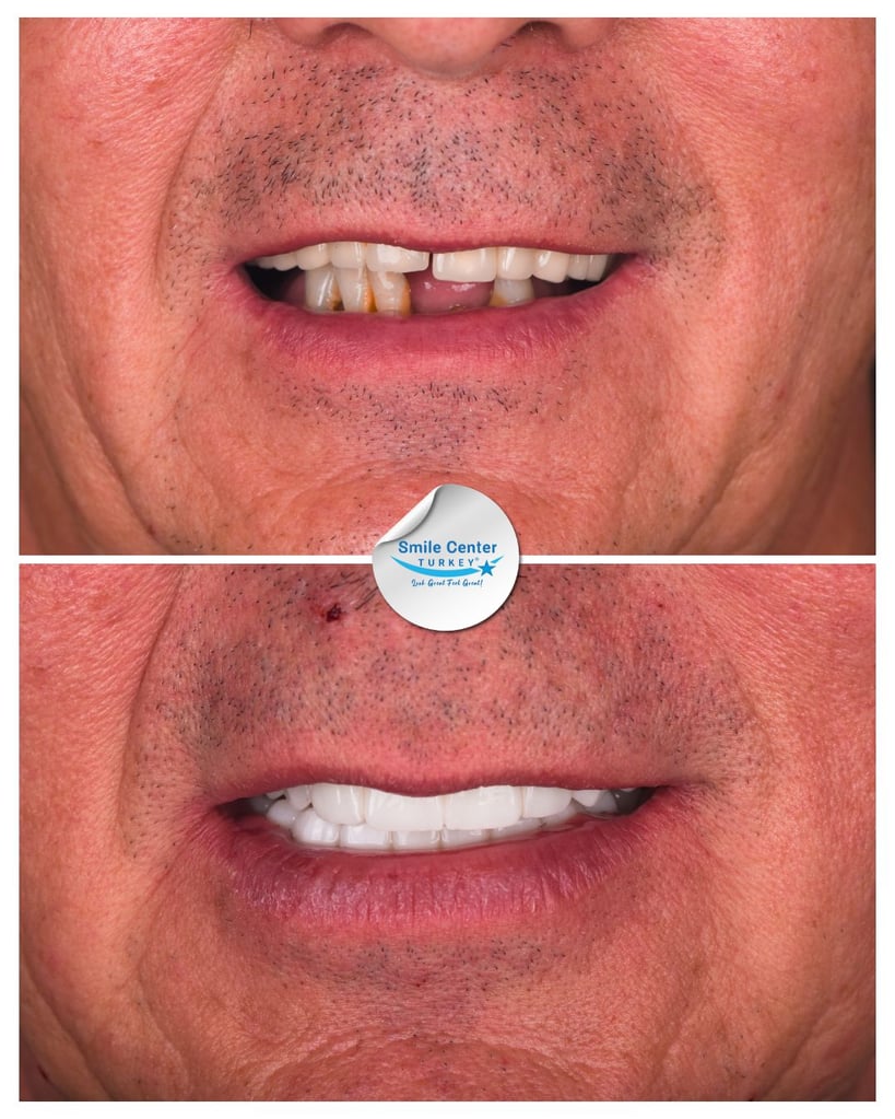 Close-up before and after front view of a male patient’s smile showing yellow, decayed and missing upper teeth before treatment and bright white teeth after dental restoration at Smile Center Turkey.