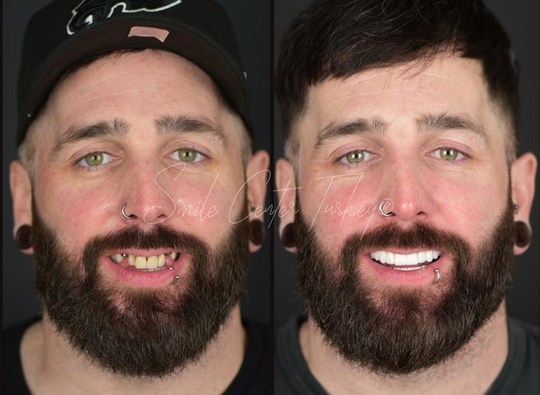 Blog – Smile Center Turkey®