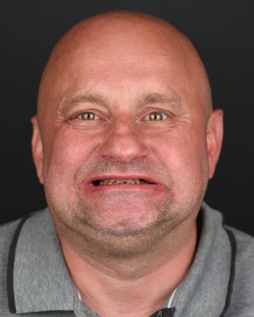 Portrait of a bald middle-aged man with a trimmed beard making a funny expression, wearing a grey polo shirt against a dark background at Smile Center Turkey.