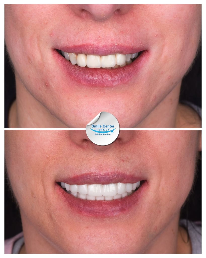 Before and after frontal view of a female patient's smile showing yellowed, misaligned teeth before treatment and white, straight teeth after dental restoration at Smile Center Turkey.
