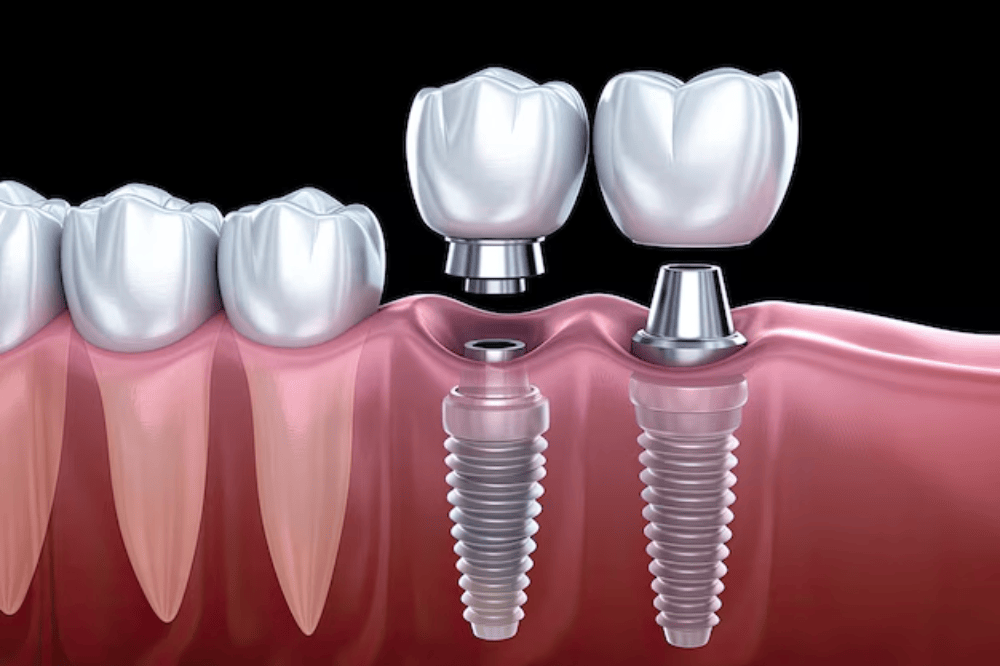 Step-by-step 3D illustration of dental implant placement showing implant screw, abutment, and crown