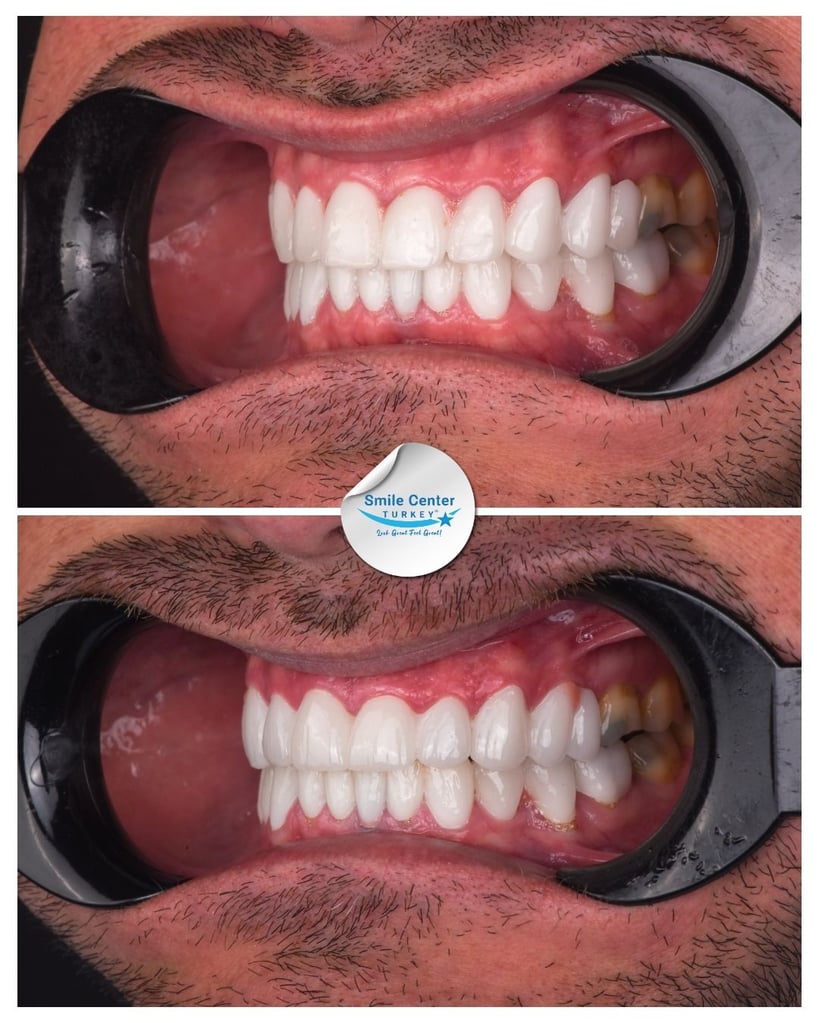 Side view of a male patient's teeth with moustache and cheek retractors showing straight white teeth after dental restoration at Smile Center Turkey.