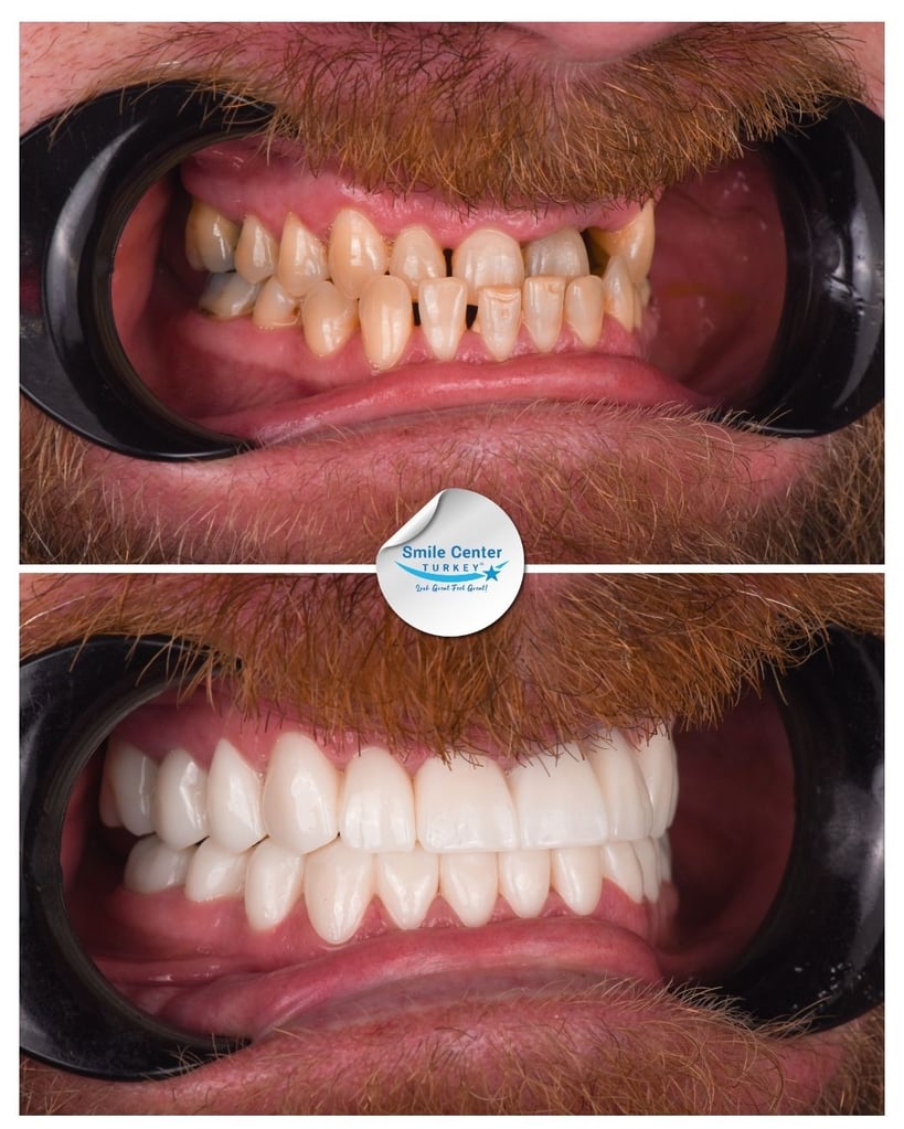 Before and after front view of a bearded male patient’s mouth showing yellow, crooked teeth before treatment and a full set of straight white teeth after dental restoration at Smile Center Turkey.