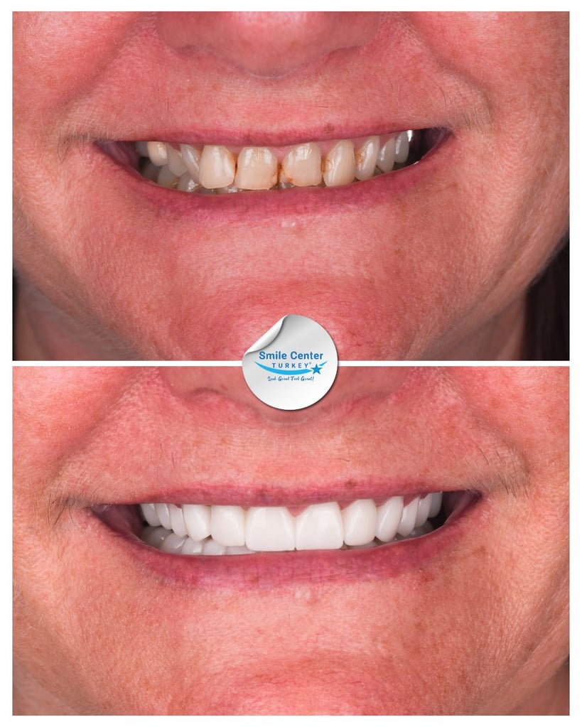 Before and after front view of a female patient’s smile showing yellow, misaligned teeth before treatment and bright, straight white teeth after dental restoration at Smile Center Turkey.