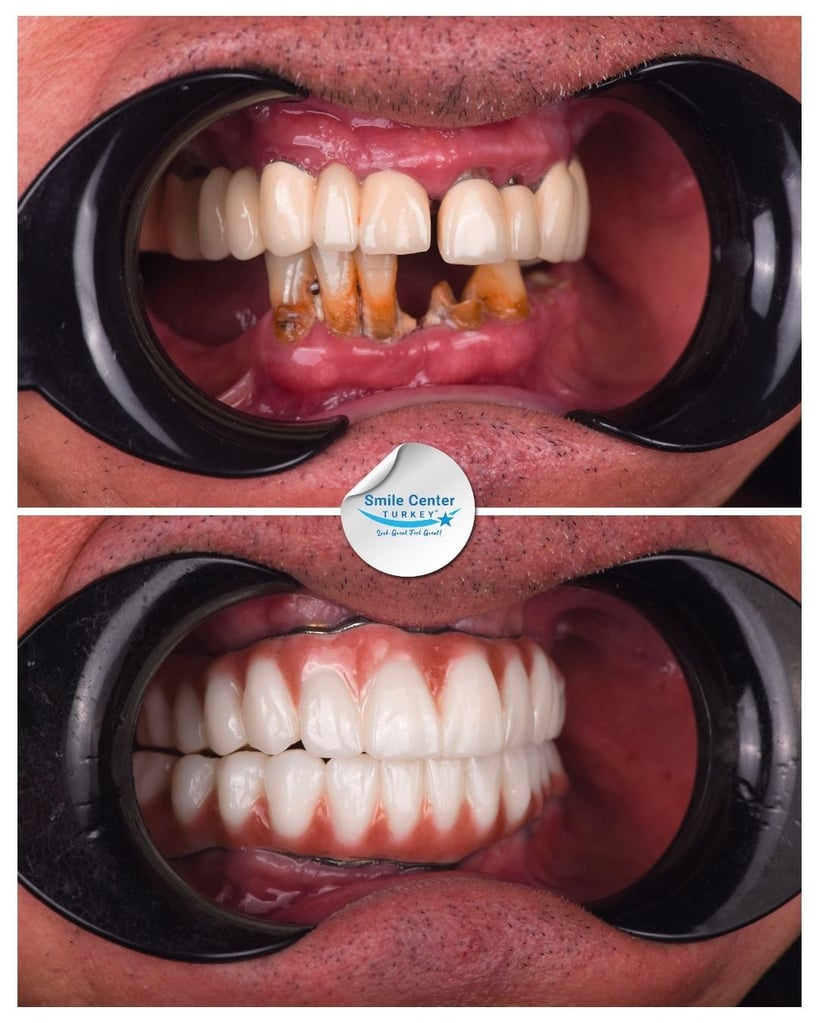 Close-up before and after front view of a patient’s mouth showing severely decayed and worn-down lower teeth before treatment and a full set of straight white teeth after dental restoration at Smile Center Turkey.