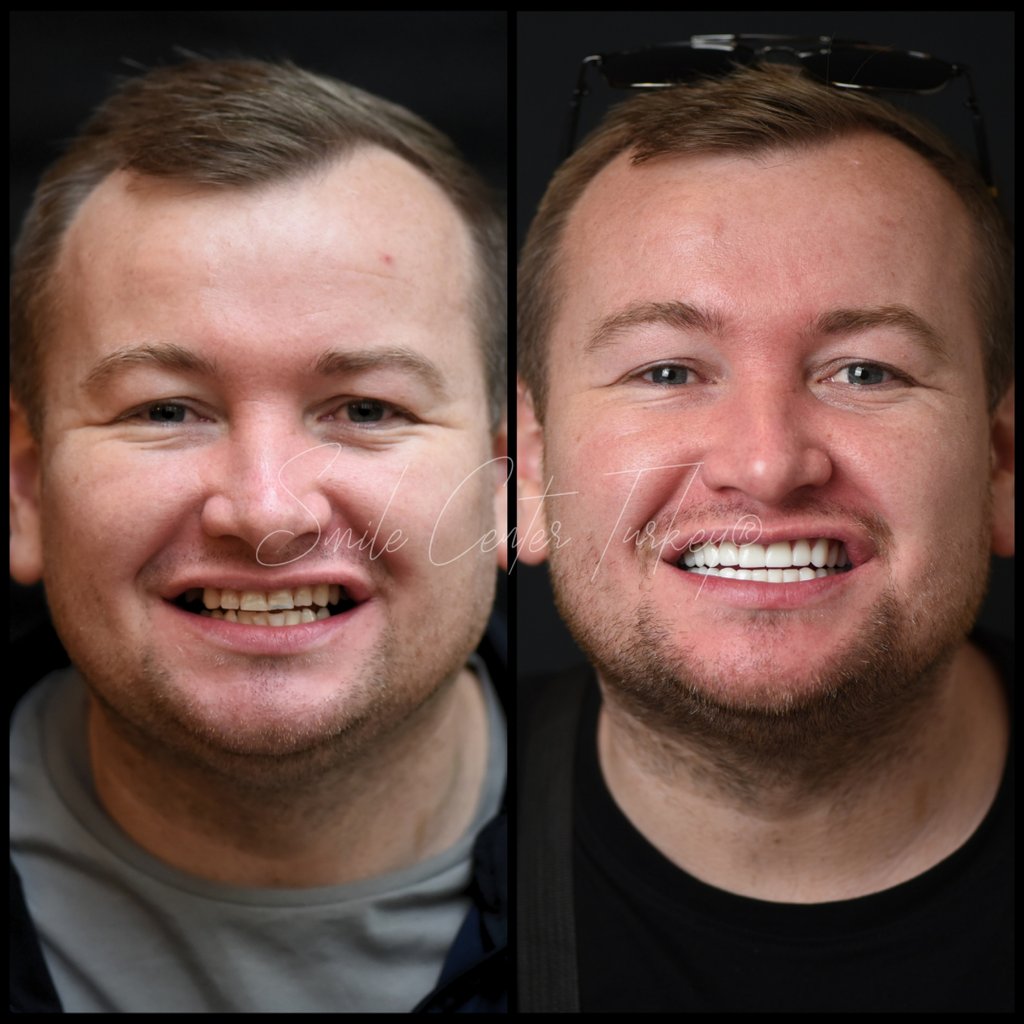 xAt Smile Center Turkey® in the heart of Antalya, our internationally accredited dentists create stunning, natural smiles with porcelain and composite veneers. Designed for UK patients seeking fast appointments, transparent pricing, and long-lasting aesthetic results.