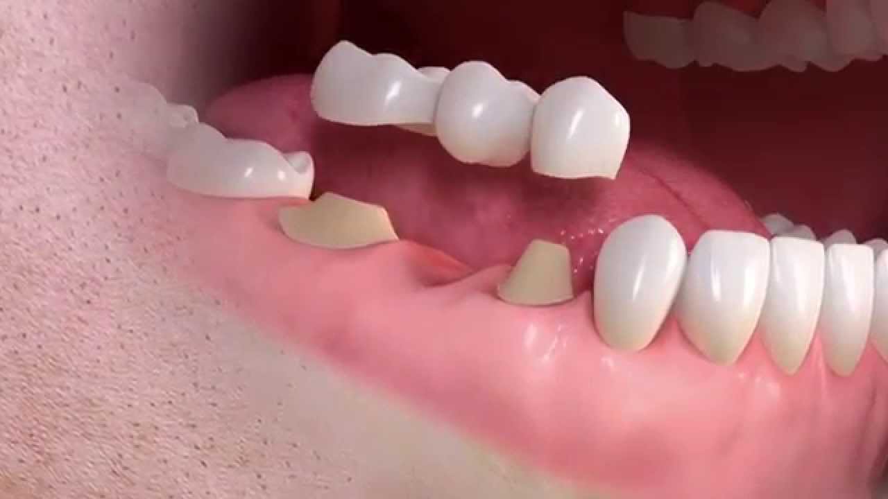 3D illustration showing a conventional 3-unit dental bridge supported by two natural teeth