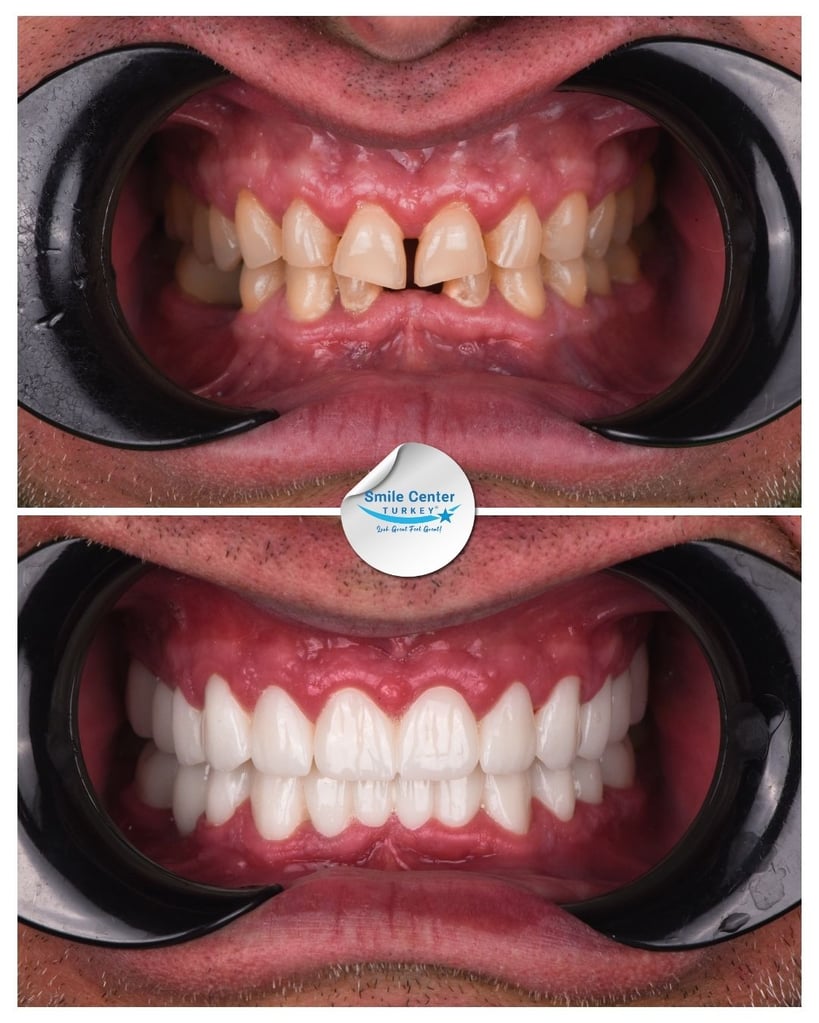 Before and after close-up of a patient’s upper and lower teeth showing crooked, discoloured teeth before treatment and straight, white teeth after dental restoration at Smile Center Turkey.