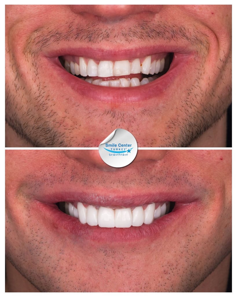 Before and after front view of a male patient's smile with stubbled moustache; top panel shows minor discoloration and uneven teeth before treatment; bottom panel shows bright, even white teeth after dental restoration at Smile Center Turkey.