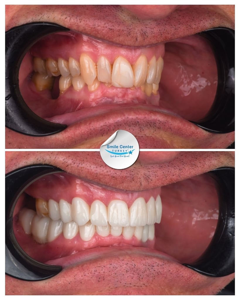 Before-and-after side view of a patient's lower and upper teeth, showing stained, crowded teeth before treatment and straight, white teeth after dental restoration at Smile Center Turkey.