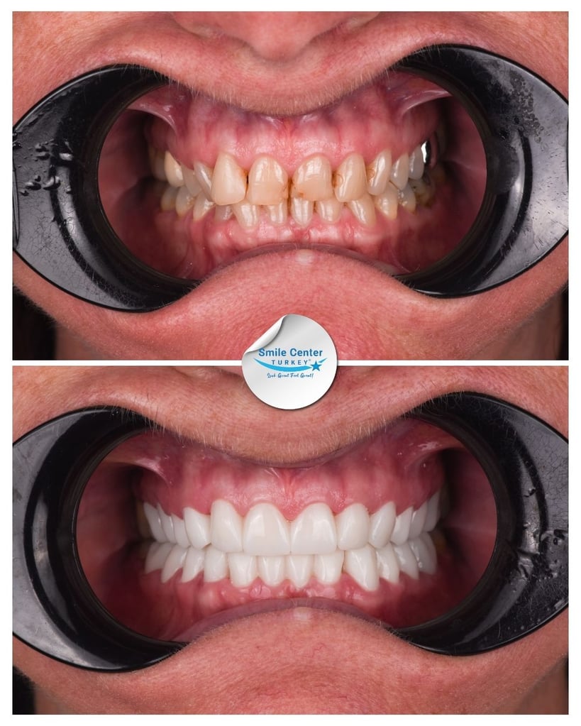 Before and after front view of a female patient's teeth with cheek retractors, showing yellowed, crooked teeth before treatment and white, straight teeth after dental restoration at Smile Center Turkey.