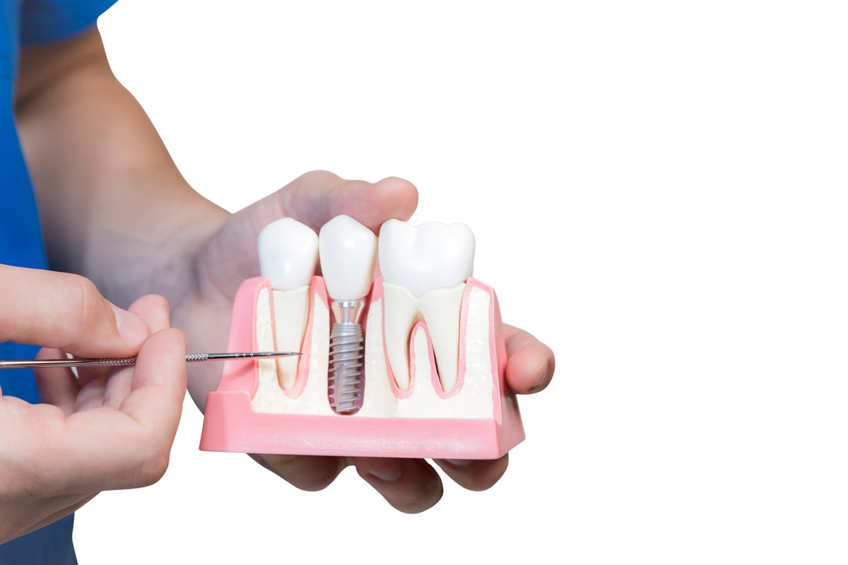 Dental implant procedure showing titanium post and crown