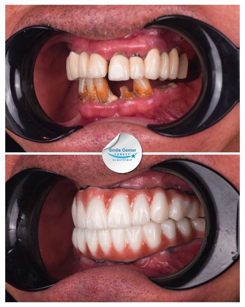 Before and after front view of a patient’s mouth showing severely decayed and worn-down lower teeth and misaligned upper teeth before treatment, and a full set of straight white teeth after dental restoration at Smile Center Turkey.