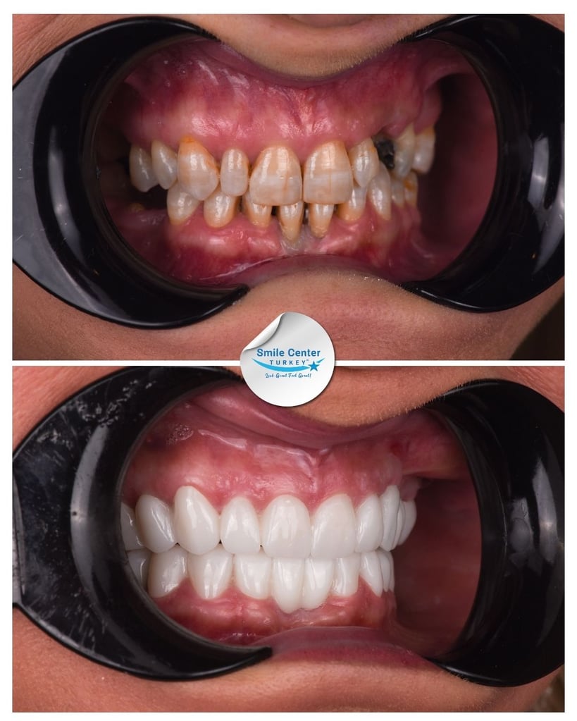 Before and after front view of a female patient’s mouth showing crowded, yellow and decayed teeth before treatment and a full set of straight white teeth after dental restoration at Smile Center Turkey.