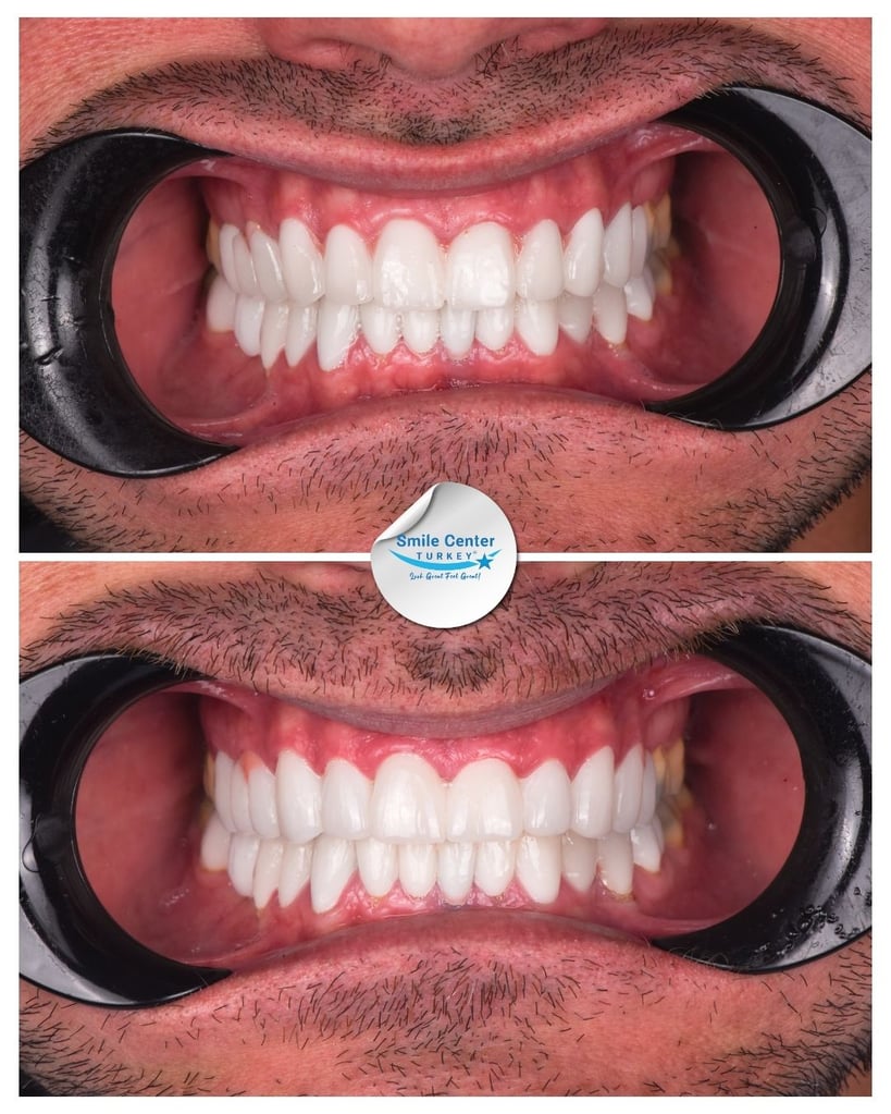 Before and after front view of a male patient's teeth with moustache and cheek retractors showing slightly different angles of straight white teeth after dental restoration at Smile Center Turkey.