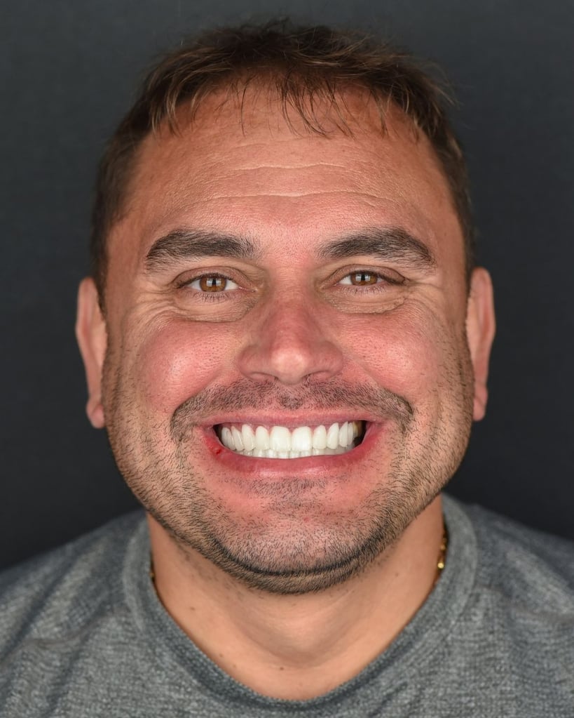 Portrait of a middle-aged man with short brown hair and a trimmed beard smiling broadly with bright white teeth, wearing a grey shirt and gold chain at Smile Center Turkey.