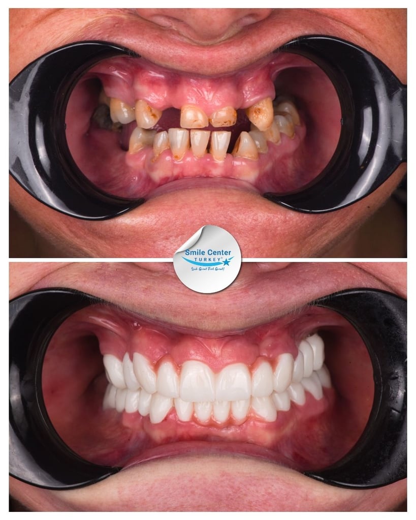 Before and after front view of a female patient's teeth using cheek retractors, showing severely decayed and missing teeth before treatment and white, straight teeth after dental restoration at Smile Center Turkey.