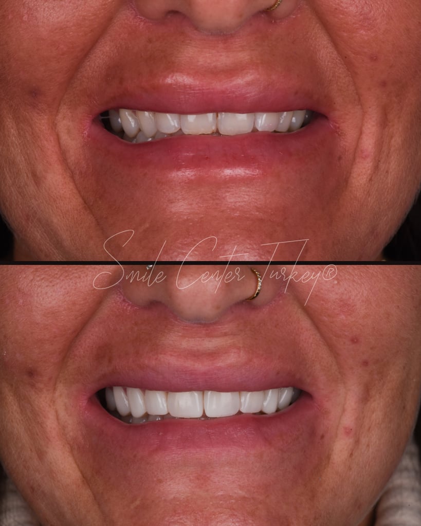 Victoria – Smile Center Turkey®