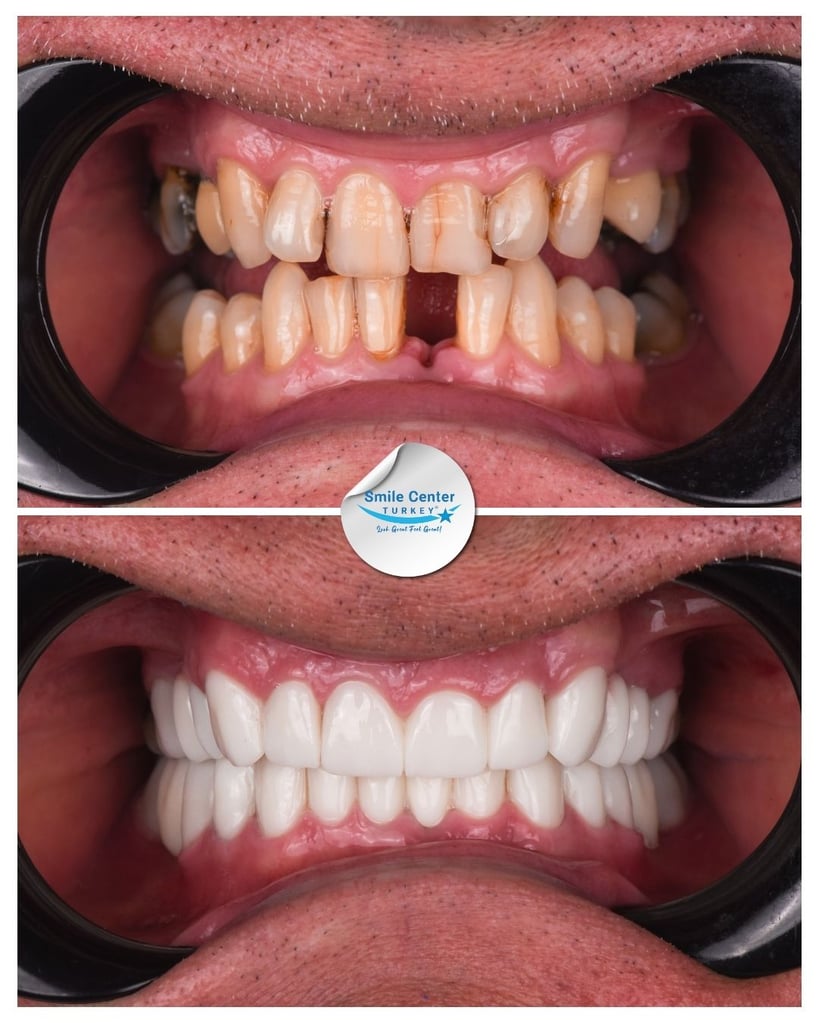 Before and after front view of a male patient's teeth with cheek retractors, showing severely decayed and misaligned teeth before treatment and white, straight teeth after dental restoration at Smile Center Turkey.