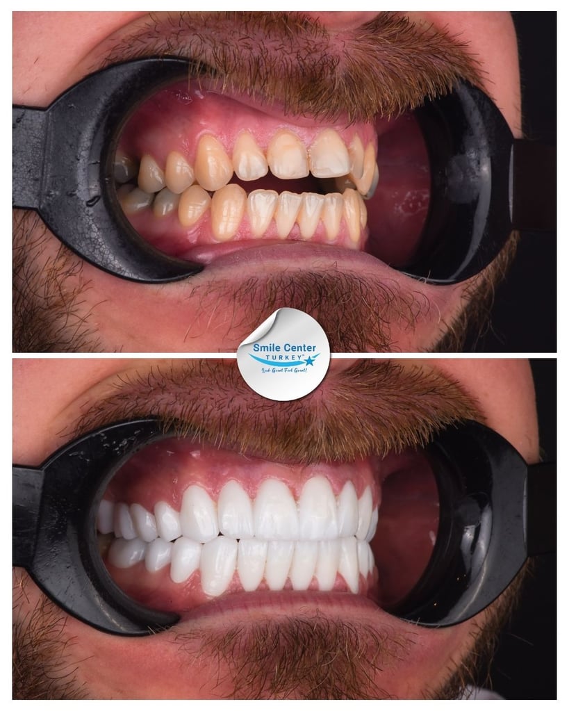Before and after side view of a male patient's teeth with moustache and cheek retractors, showing yellowed, crowded teeth before treatment and white, straight teeth after dental restoration at Smile Center Turkey.
