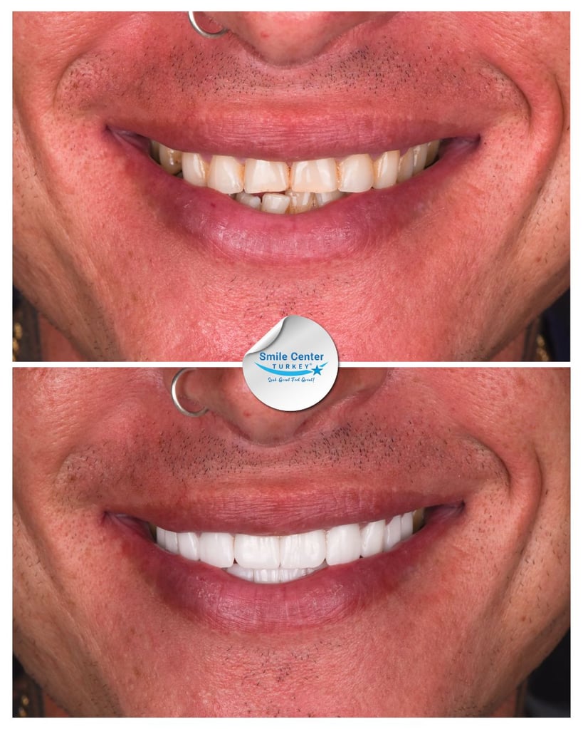 Before-and-after smile photo showing dental restoration at Smile Center Turkey.